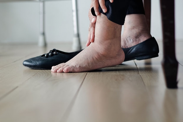Όλα όσα πρέπει να γνωρίζετε για το διαβητικό πόδι