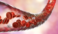 Ενδαγγειακή χειρουργική με stent